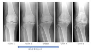 変形性膝関節症