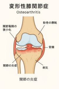 変形性膝関節症